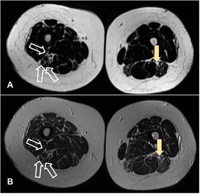 Imatinib-induced dermatomyositis sine dermatitis - a rare case report